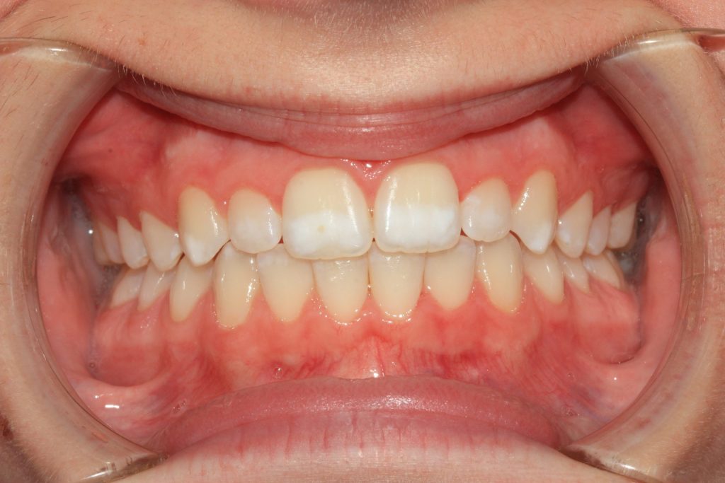 Before image of dental patient’s mouth with white spot lesions (WSLs) on top of after image of teeth treated with icon.