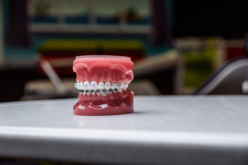 Model of traditional metal orthodontic braces in the dental office. 