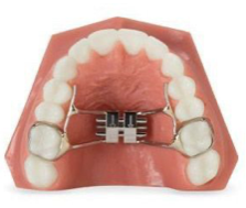 A close up view of a rapid palatal expander.

